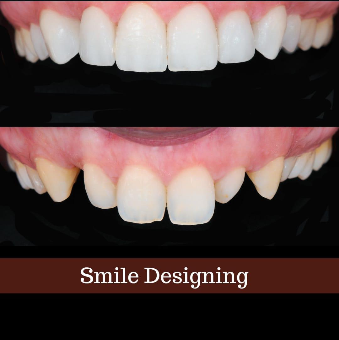 Smile Designing