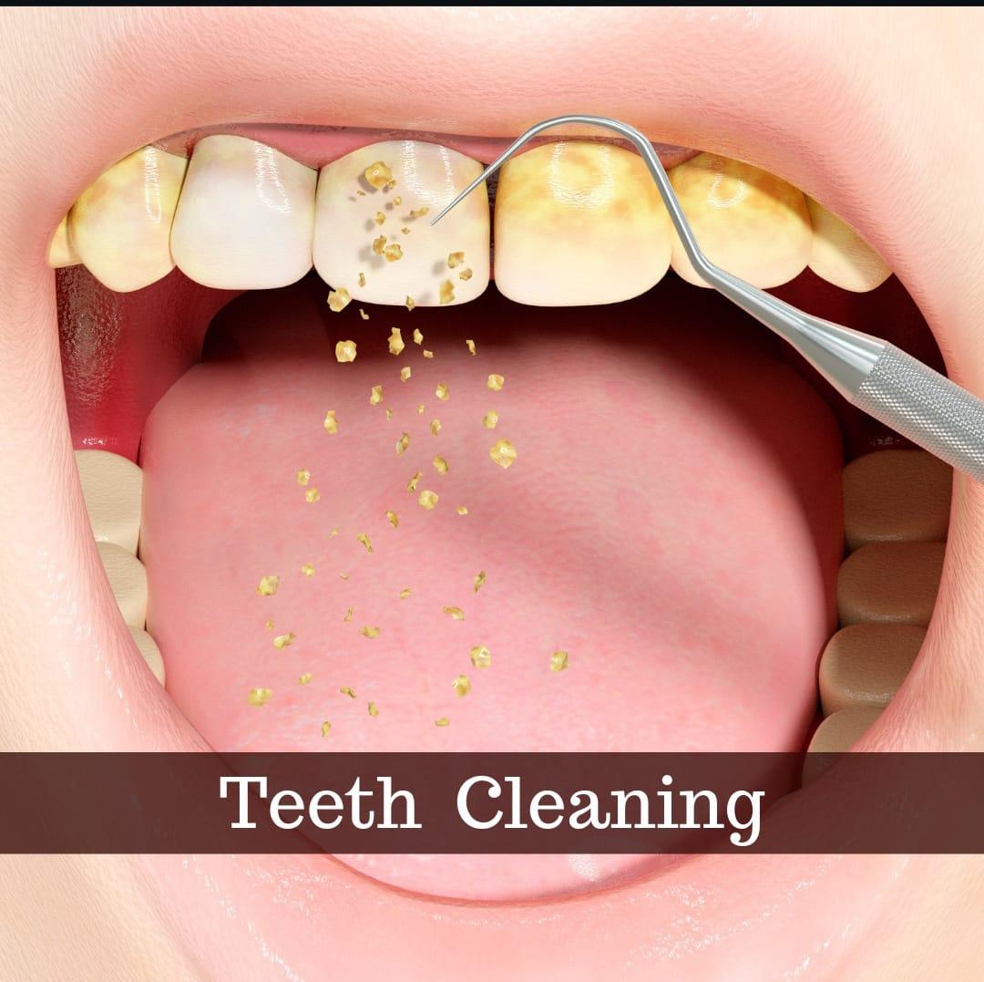 Teeth Cleaning