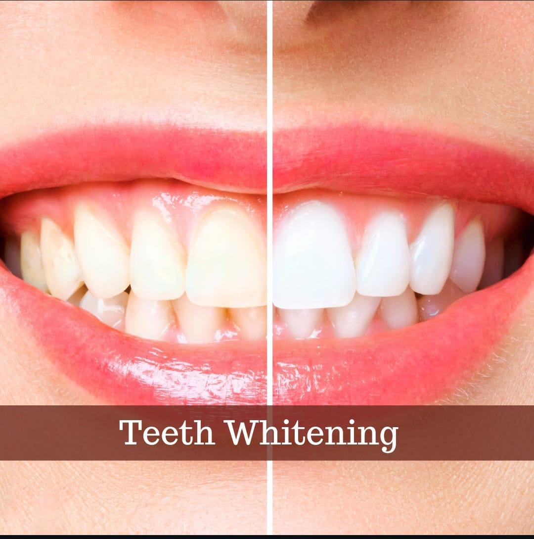 Teeth Whitening